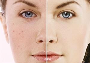 6 توصیه برای داشتن پوستی صاف و بدون لک