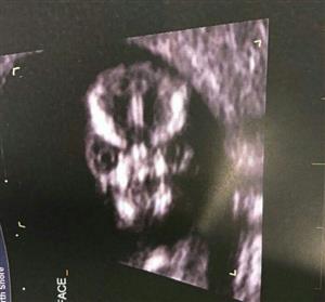 جنین ترسناک در سونوگرافی باعث وحشت زن باردار شد+عکس

