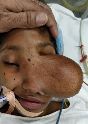 تومور وحشتناک و بدشکل بینی دختر 15 ساله+تصاویر
