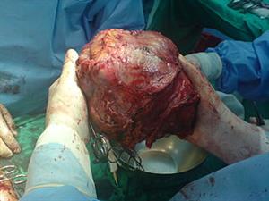 تومور ۱۱ کیلویی در شکم زن +عکس
