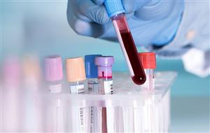 لخته شدن خون در افراد کرونایی مربوط به پاسخ آنتی‌بادی غیرطبیعی است