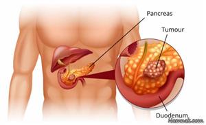 سرطان پانکراس؛ وحشتناک‌ ترین نوع سرطان بدون علامت